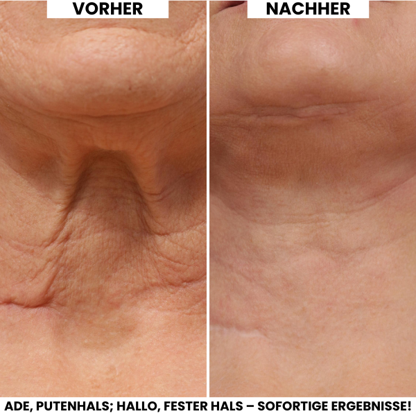 Evonex® Straffende™ Halscreme